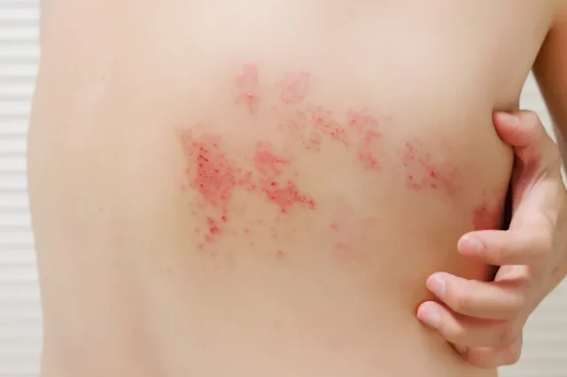 帯状疱疹の初期症状の画像